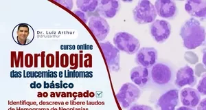 O Curso Morfologia das Leucemias e Linfomas Funciona? Sim, o Curso Morfologia das Leucemias e Linfomas funciona. No vasto campo da hematologia, a interpretação precisa dos resultados de mielogramas e hemogramas é crucial para o diagnóstico e tratamento eficazes de uma variedade de condições, desde leucemias agudas até outras neoplasias hematológicas. Entretanto, compreender e interpretar adequadamente os achados morfológicos presentes nessas análises pode ser desafiador e requer conhecimento especializado. O Curso Morfologia das Leucemias e Linfomas Vale a Pena? Sim, o Curso Morfologia das Leucemias e Linfomas vale a pena. Desenvolvido por especialistas renomados no campo da hematologia, este curso oferece uma oportunidade única para profissionais da saúde aprimorarem suas habilidades na interpretação de resultados hematológicos, especialmente aqueles relacionados às leucemias agudas, leucemias crônicas, mieloma, linfomas e outras neoplasias hematológicas. Para quem o Curso Morfologia das Leucemias e Linfomas é Bom? Hematologistas. Patologistas. Médicos residentes em hematologia ou patologia. Enfermeiros especializados em hematologia. Técnicos de laboratório com foco em hematologia. Estudantes de medicina interessados em hematologia ou patologia.